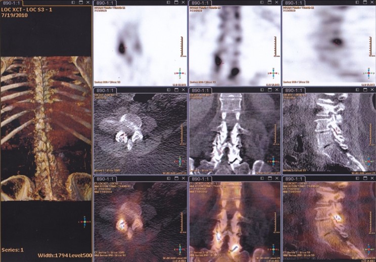 Western Nuclear Medicine BONE Scan (SPECT/CT)